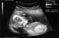 Little Ben Sonogram